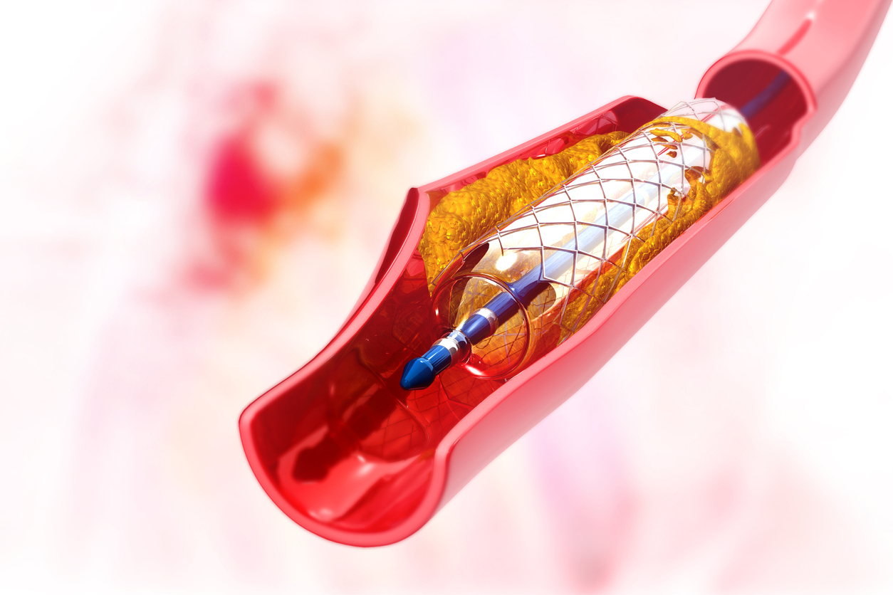 Stent no coração